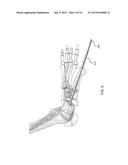 DEVICES AND METHODS FOR BONE FIXATION USING AXIAL IMPLANTS diagram and image