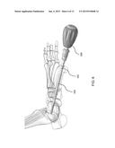 DEVICES AND METHODS FOR BONE FIXATION USING AXIAL IMPLANTS diagram and image