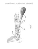 DEVICES AND METHODS FOR BONE FIXATION USING AXIAL IMPLANTS diagram and image