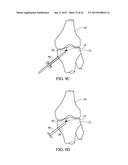 SUBCHONDRAL TREATMENT OF JOINT PAIN diagram and image