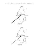 SUBCHONDRAL TREATMENT OF JOINT PAIN diagram and image