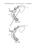 SUBCHONDRAL TREATMENT OF JOINT PAIN diagram and image