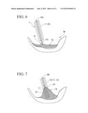 TISSUE RESECTION APPARATUS diagram and image