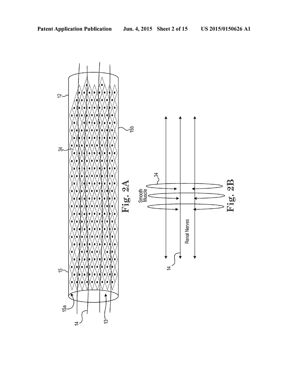 BIPOLAR OFF-WALL ELECTRODE DEVICE FOR RENAL NERVE ABLATION - diagram, schematic, and image 03