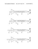 Pressure Wave Root Canal Cleaning System diagram and image