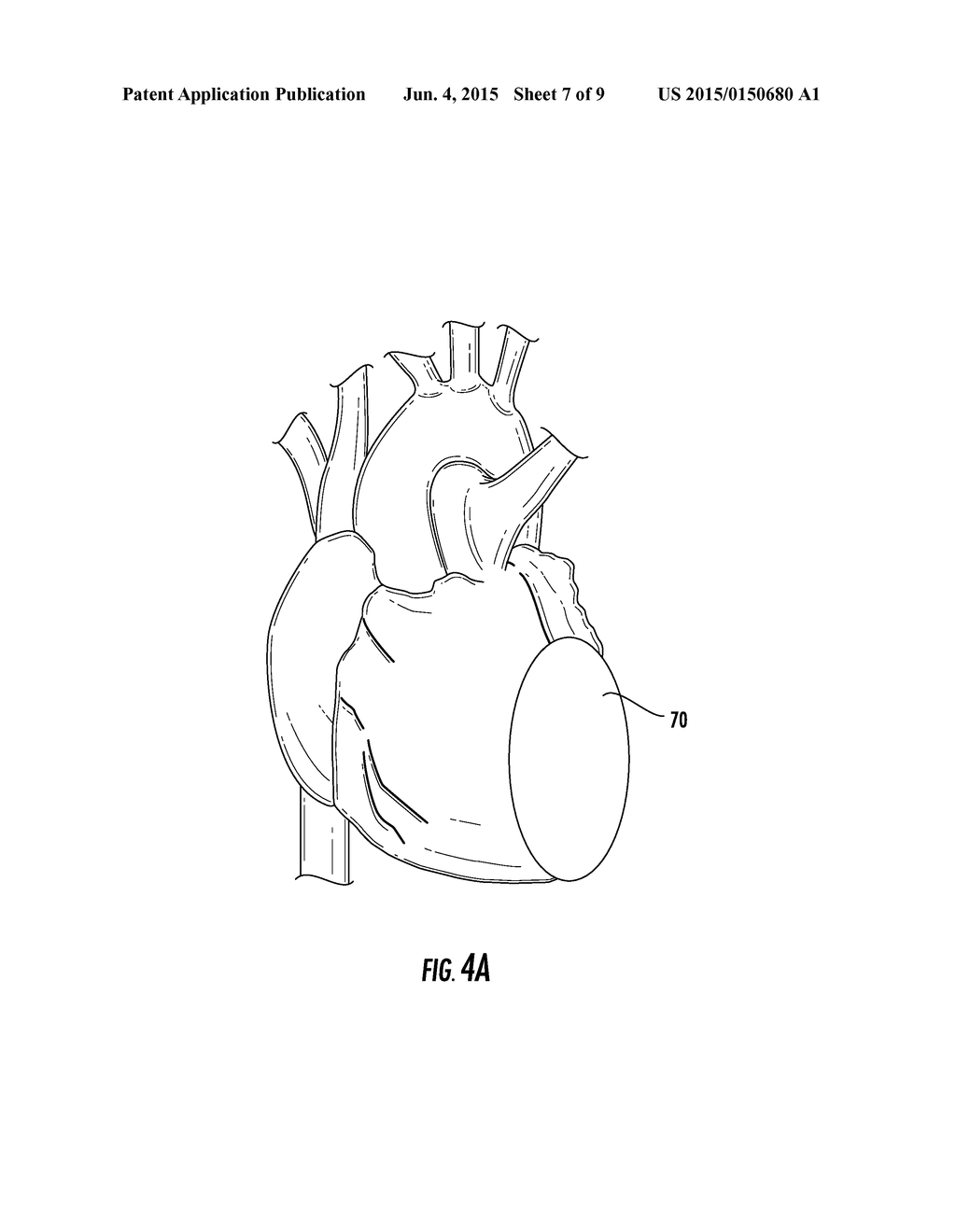 BIOACTIVE IMPLANT FOR MYOCARDIAL REGENERATION AND VENTRICULAR CHAMBER     RESTORATION - diagram, schematic, and image 08