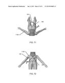 ORTHOPEDIC ANCHORING SYSTEM AND METHODS diagram and image