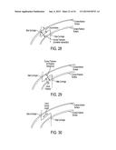 LASER EYE SURGERY SYSTEM diagram and image