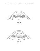 LASER EYE SURGERY SYSTEM diagram and image