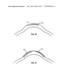 LASER EYE SURGERY SYSTEM diagram and image