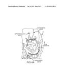 EXTRACRANIAL IMPLANTABLE DEVICES, SYSTEMS AND METHODS FOR THE TREATMENT OF     NEUROPSYCHIATRIC DISORDERS diagram and image