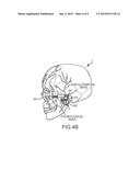 EXTRACRANIAL IMPLANTABLE DEVICES, SYSTEMS AND METHODS FOR THE TREATMENT OF     NEUROPSYCHIATRIC DISORDERS diagram and image