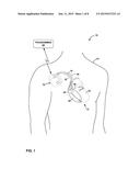 IDENTIFICATION OF ABNORMAL CARDIAC SUBSTRATE DURING LEFT-VENTRICULAR     PACING diagram and image