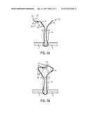 KNOTLESS COLLAPSIBLE SUTURES AND METHODS FOR SUTURING diagram and image