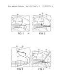 SWIVEL ANCHOR FOR KNOTLESS FIXATION OF TISSUE diagram and image