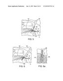 SWIVEL ANCHOR FOR KNOTLESS FIXATION OF TISSUE diagram and image