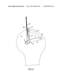 Tissue Repair Suture Plates and Methods of Use diagram and image