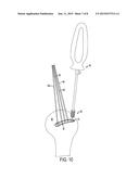 Tissue Repair Suture Plates and Methods of Use diagram and image