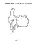 Steerable Endoluminal Punch diagram and image