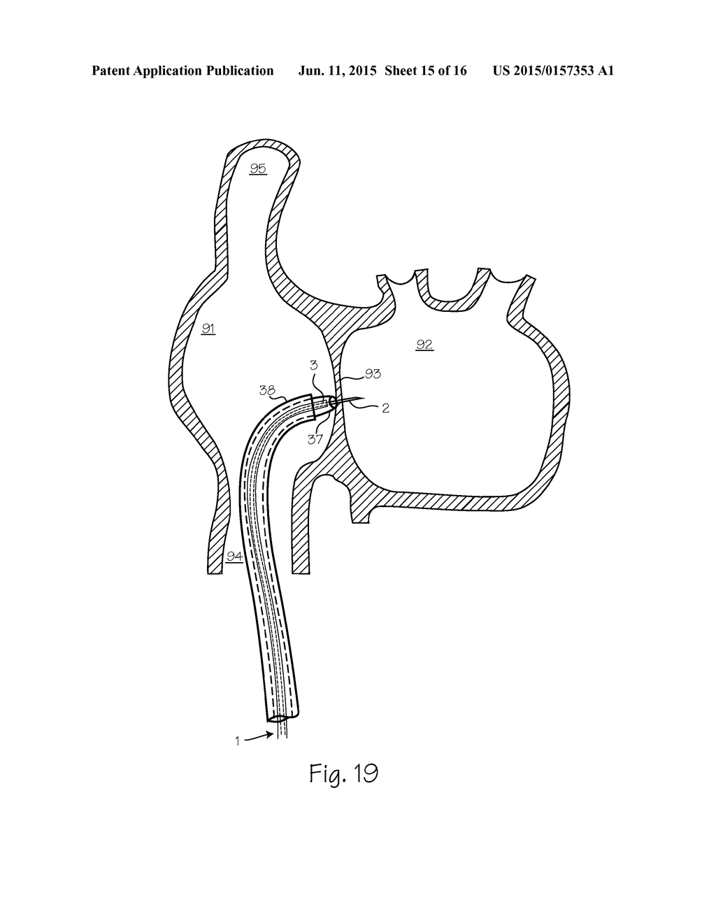 Steerable Endoluminal Punch - diagram, schematic, and image 16