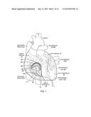 PERICARDIAL CATHETER WITH TEMPERATURE SENSING ARRAY diagram and image