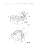 DENTAL BRIDGE ATTACHMENT SYSTEM AND METHOD diagram and image