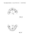 DENTAL BRIDGE ATTACHMENT SYSTEM AND METHOD diagram and image