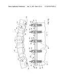 DENTAL BRIDGE ATTACHMENT SYSTEM AND METHOD diagram and image