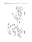 DENTAL BRIDGE ATTACHMENT SYSTEM AND METHOD diagram and image