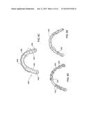 DENTAL BRIDGE ATTACHMENT SYSTEM AND METHOD diagram and image