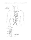 Method of Treating Occlusion in a Blood Vessel diagram and image