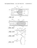 Method of Treating Occlusion in a Blood Vessel diagram and image