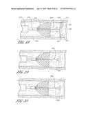 Method of Treating Occlusion in a Blood Vessel diagram and image