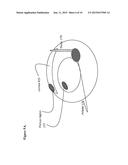 DEVICES AND METHODS FOR GENERATION OF SUBSURFACE MICRO-DISRUPTIONS FOR     OPTHALMIC SURGERY AND OPTHALMIC APPLICATIONS diagram and image