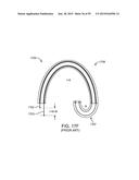 ENDOSCOPIC DEVICE WITH DOUBLE-HELICAL LUMEN DESIGN diagram and image