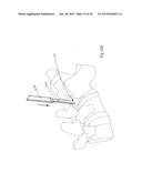 METHODS FOR FACET JOINT TREATMENT diagram and image