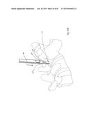 METHODS FOR FACET JOINT TREATMENT diagram and image