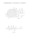 METHODS FOR FACET JOINT TREATMENT diagram and image