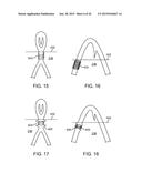 ADVANCED ENDOVASCULAR GRAFT AND DELIVERY SYSTEM diagram and image