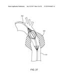 ADVANCED ENDOVASCULAR GRAFT AND DELIVERY SYSTEM diagram and image