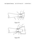 Method and Device for Improved Hygiene During Endoscopic Procedures diagram and image