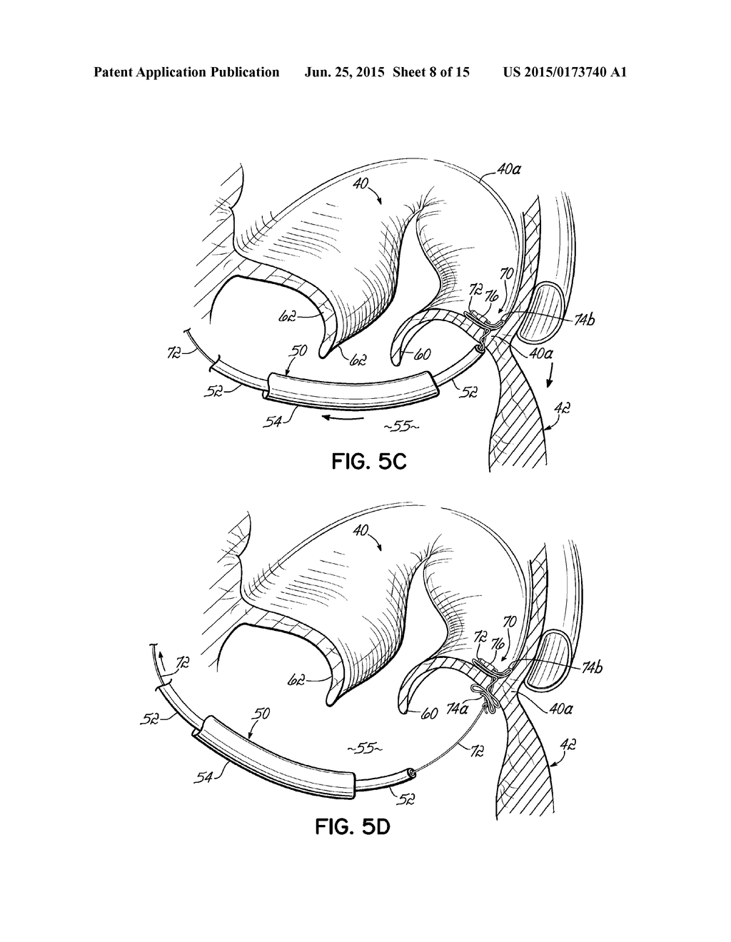 TISSUE ANCHOR AND ANCHORING SYSTEM - diagram, schematic, and image 09