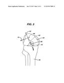 METHODS FOR LIGAMENT RECONSTRUCTION diagram and image