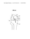 METHODS FOR LIGAMENT RECONSTRUCTION diagram and image