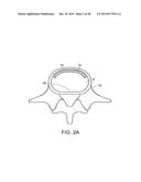 IN-SITU FORMED INTERVERTEBRAL FUSION DEVICE AND METHOD diagram and image