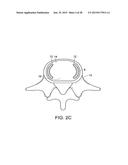 IN-SITU FORMED INTERVERTEBRAL FUSION DEVICE AND METHOD diagram and image