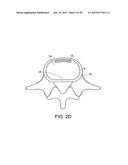 IN-SITU FORMED INTERVERTEBRAL FUSION DEVICE AND METHOD diagram and image