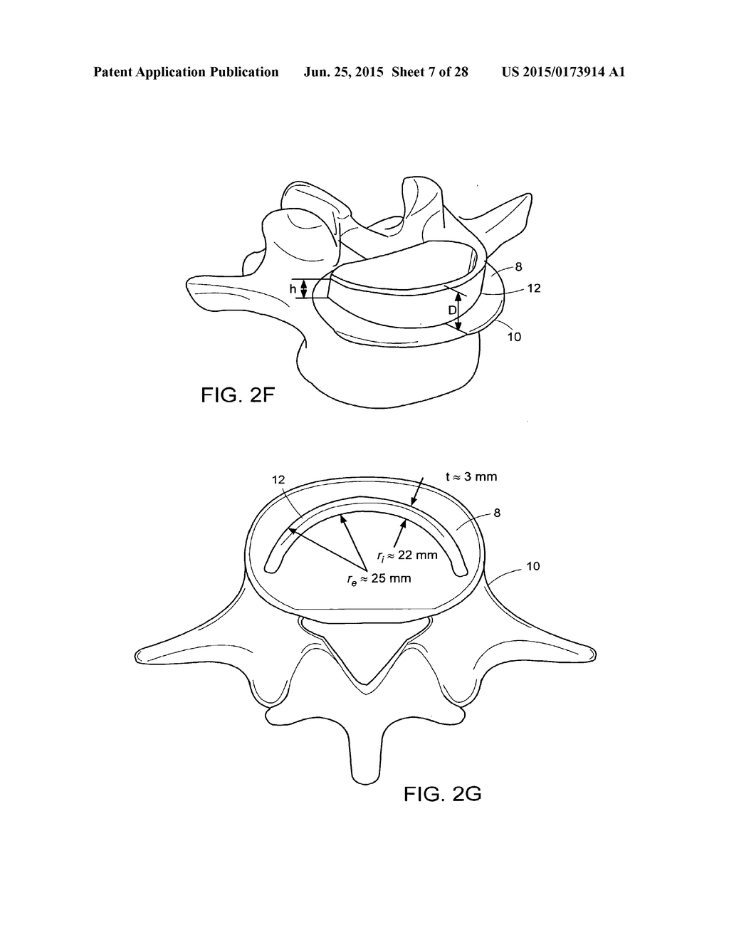 IN-SITU FORMED INTERVERTEBRAL FUSION DEVICE AND METHOD - diagram, schematic, and image 08