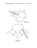 IN-SITU FORMED INTERVERTEBRAL FUSION DEVICE AND METHOD diagram and image