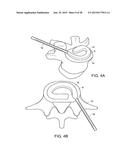 IN-SITU FORMED INTERVERTEBRAL FUSION DEVICE AND METHOD diagram and image